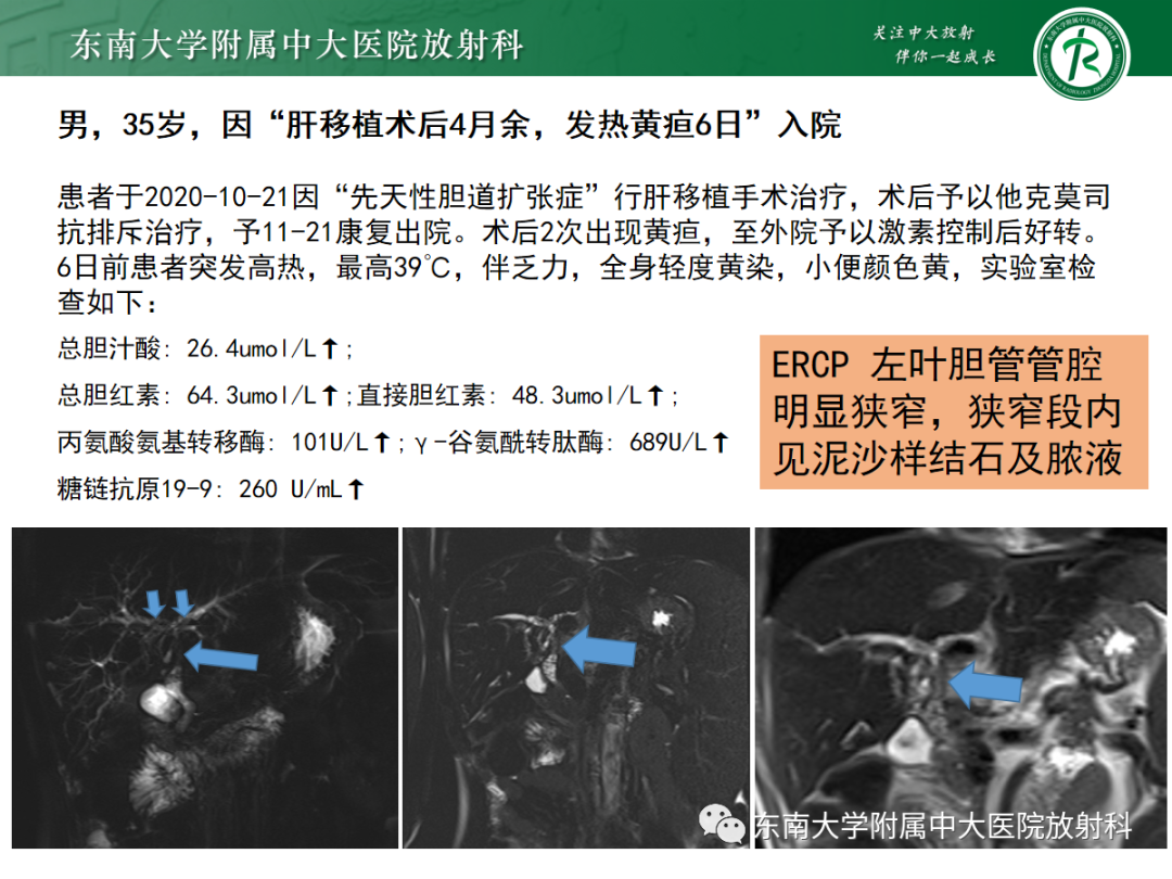 影像PPT - 【病例】胆管狭窄3例X线CT及MR病例随访-35 影像PPT - 【病例】胆管狭窄3例X线CT及MR病例随访-35