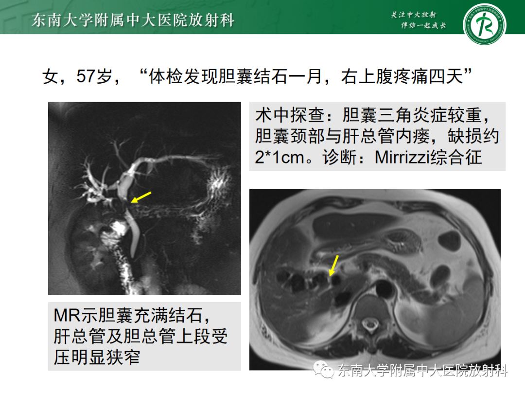 影像PPT - 【病例】胆管狭窄3例X线CT及MR病例随访-38 影像PPT - 【病例】胆管狭窄3例X线CT及MR病例随访-38