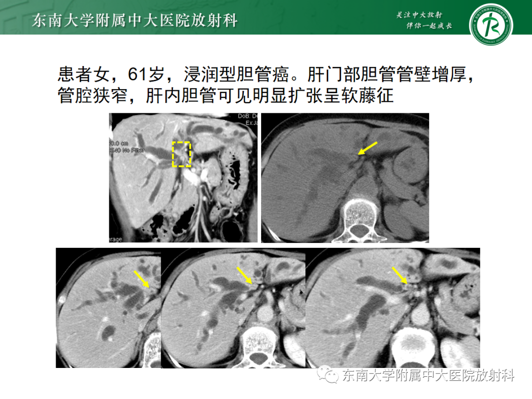 影像PPT - 【病例】胆管狭窄3例X线CT及MR病例随访-41 影像PPT - 【病例】胆管狭窄3例X线CT及MR病例随访-41