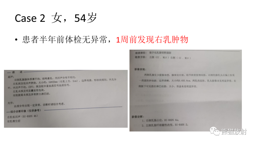 影像PPT - 【病例】乳腺叶状肿瘤2例MR影像-13