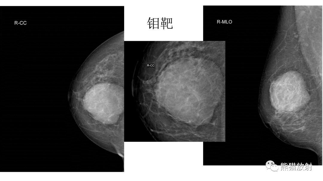 影像PPT - 【病例】乳腺叶状肿瘤2例MR影像-14