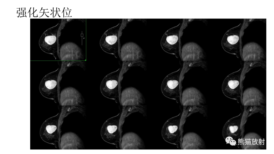影像PPT - 【病例】乳腺叶状肿瘤2例MR影像-20