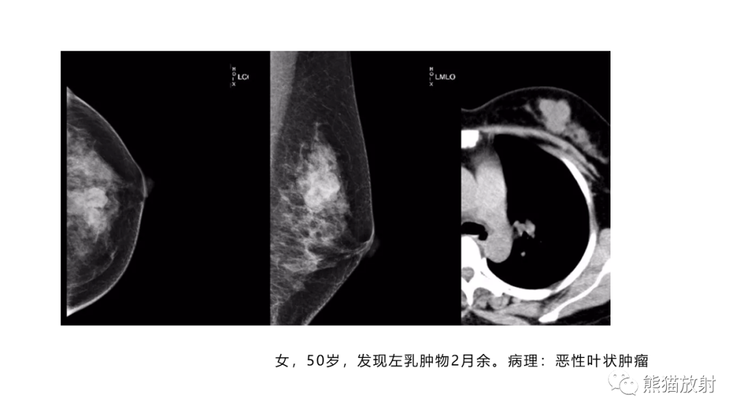影像PPT - 【病例】乳腺叶状肿瘤2例MR影像-31