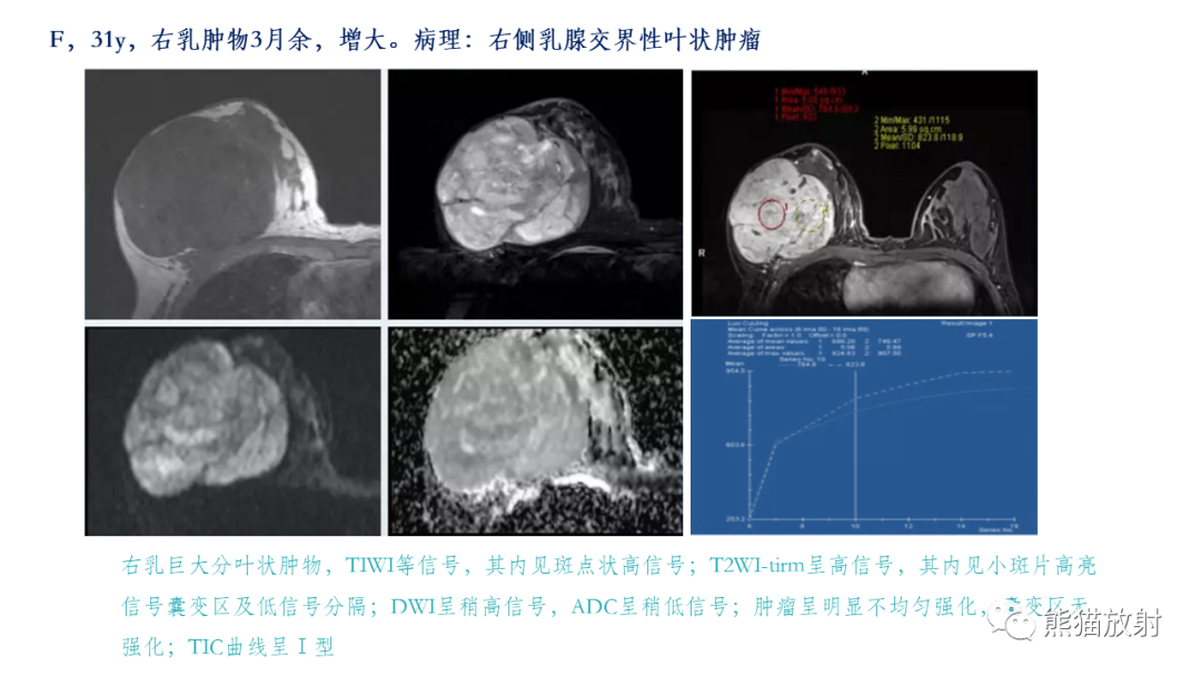 影像PPT - 【病例】乳腺叶状肿瘤2例MR影像-32