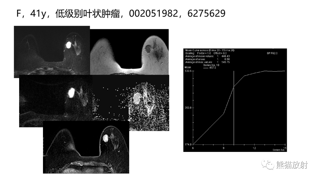 影像PPT - 【病例】乳腺叶状肿瘤2例MR影像-33