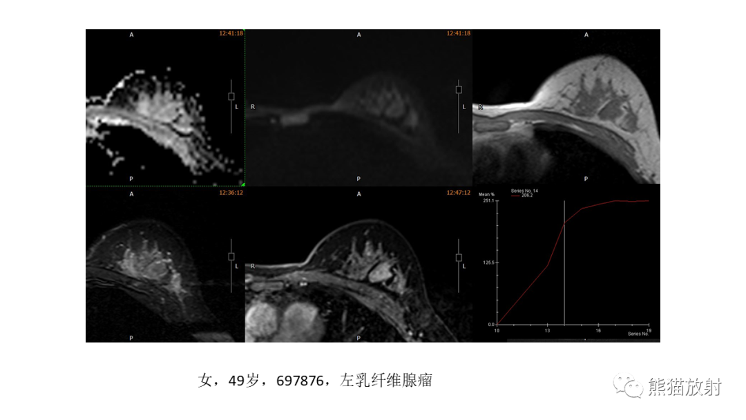 影像PPT - 【病例】乳腺叶状肿瘤2例MR影像-35