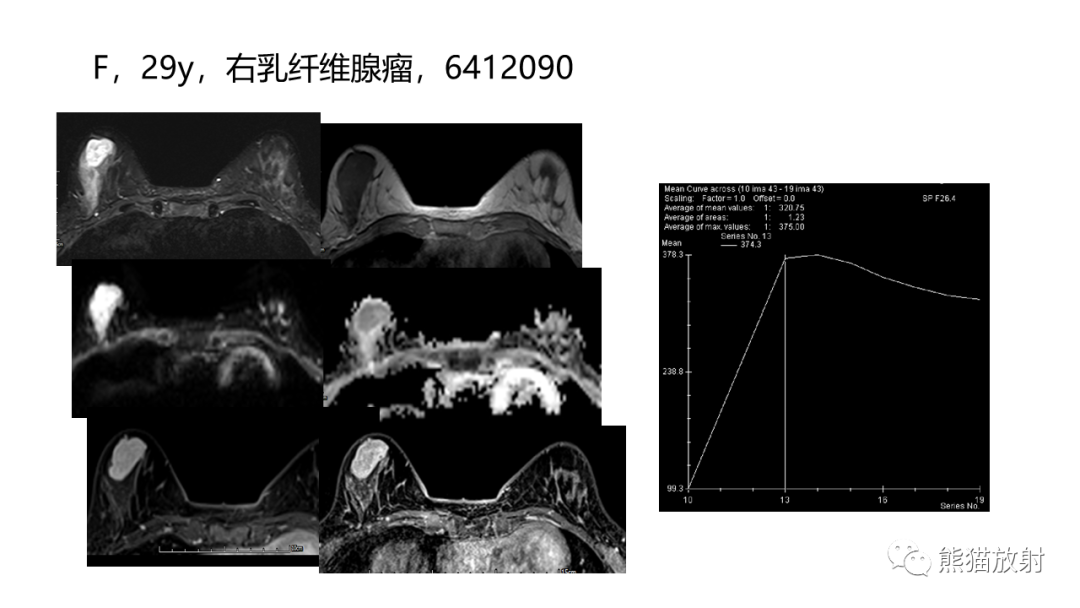 影像PPT - 【病例】乳腺叶状肿瘤2例MR影像-36