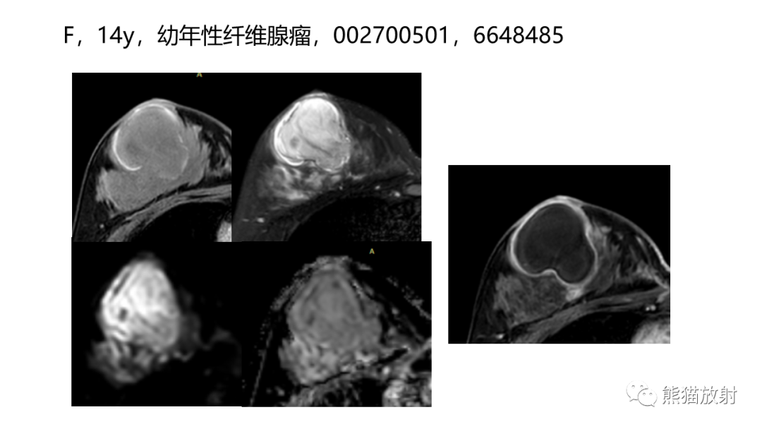 影像PPT - 【病例】乳腺叶状肿瘤2例MR影像-37