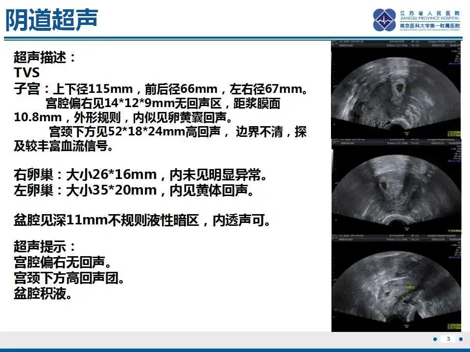 影像PPT - 【PPT】子宫内膜息肉-4