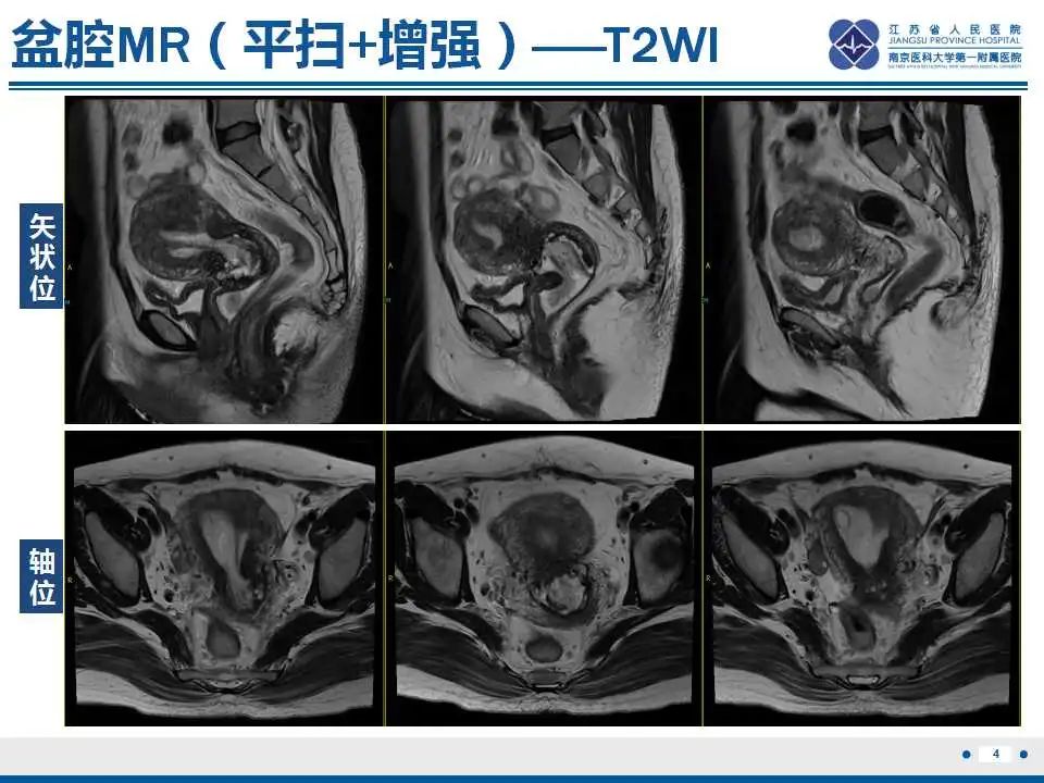 影像PPT - 【PPT】子宫内膜息肉-5