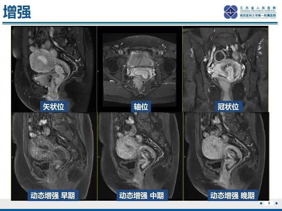 影像PPT - 【PPT】子宫内膜息肉-7