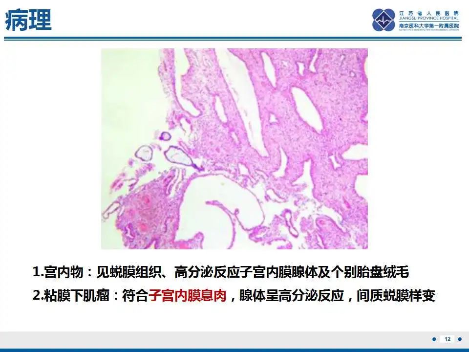 影像PPT - 【PPT】子宫内膜息肉-13