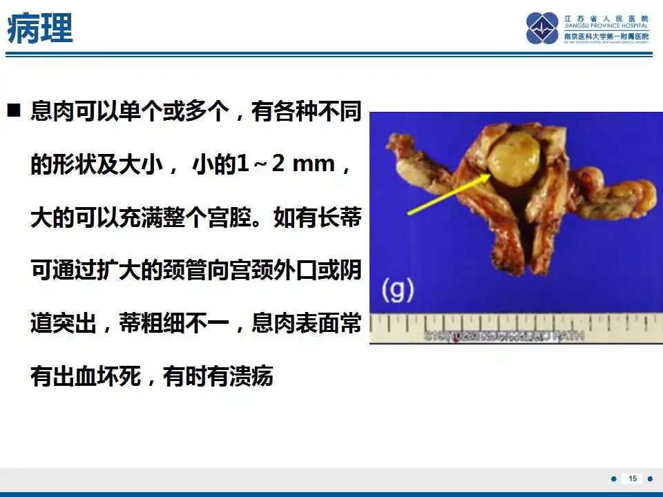 影像PPT - 【PPT】子宫内膜息肉-16