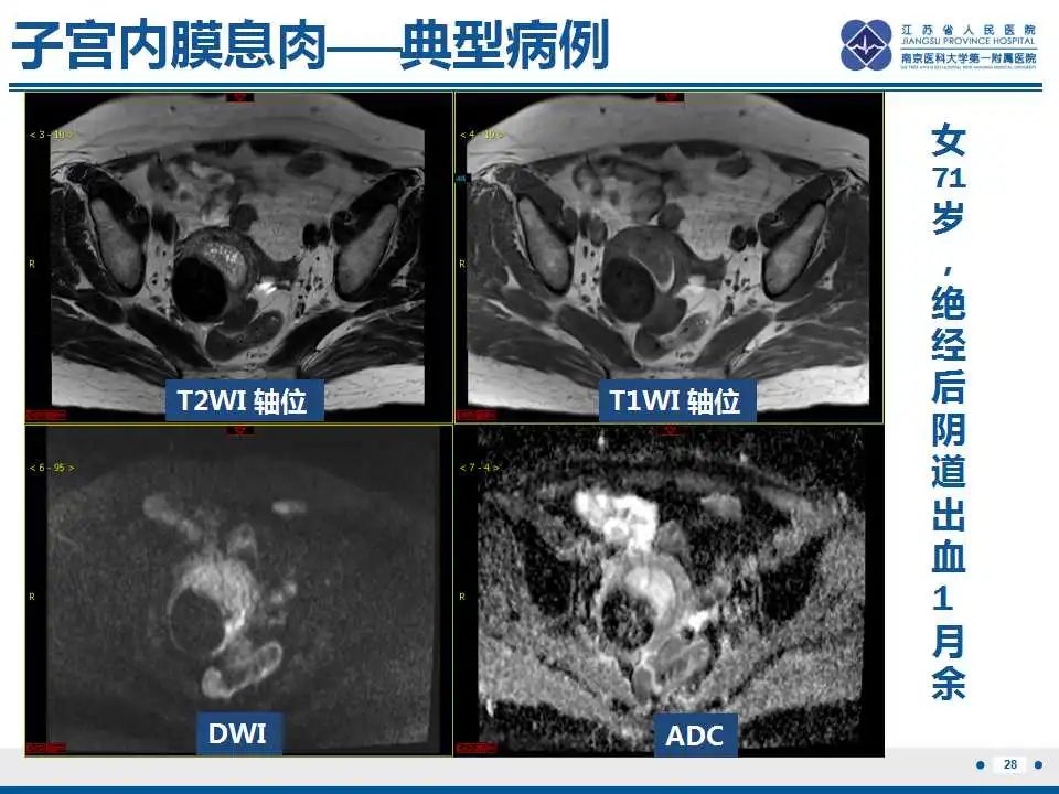 影像PPT - 【PPT】子宫内膜息肉-29