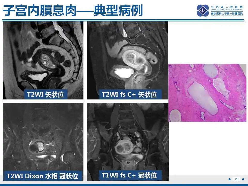 影像PPT - 【PPT】子宫内膜息肉-30