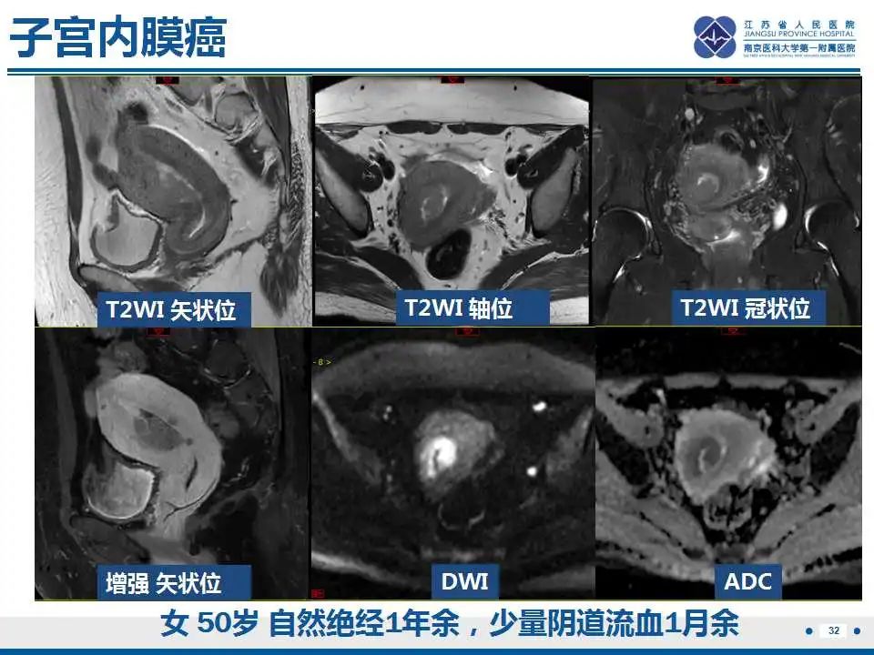 影像PPT - 【PPT】子宫内膜息肉-33