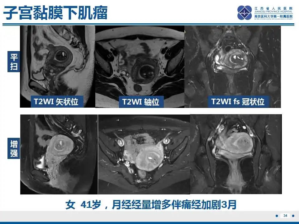 影像PPT - 【PPT】子宫内膜息肉-35