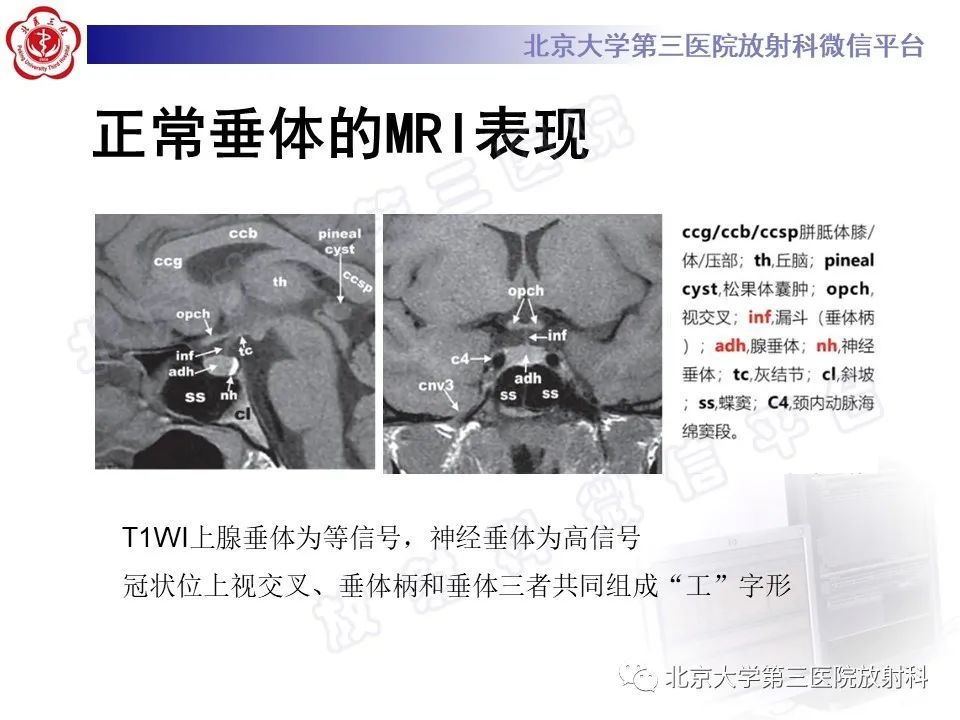 影像PPT - 【PPT】垂体病变的MRI诊断思路-5