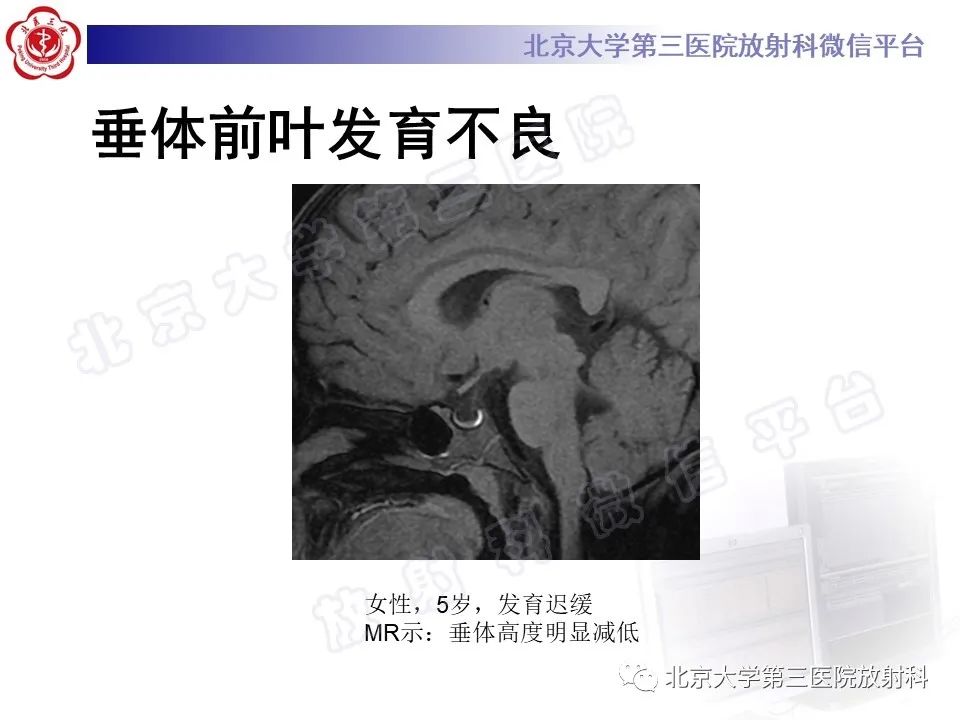 影像PPT - 【PPT】垂体病变的MRI诊断思路-10