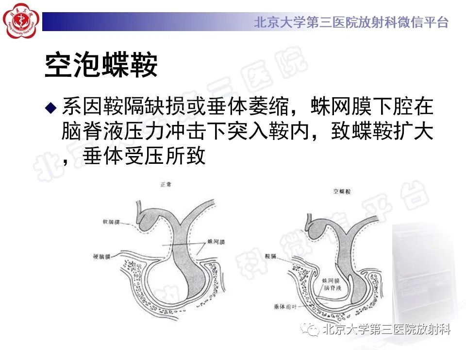 影像PPT - 【PPT】垂体病变的MRI诊断思路-12