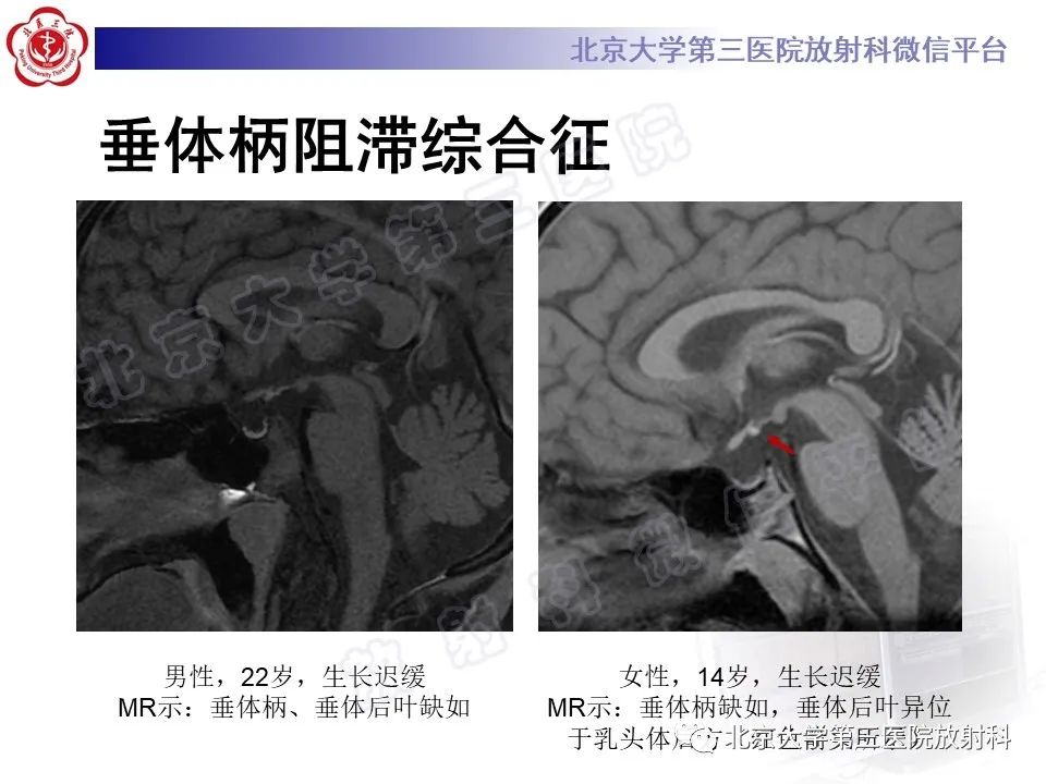 影像PPT - 【PPT】垂体病变的MRI诊断思路-11