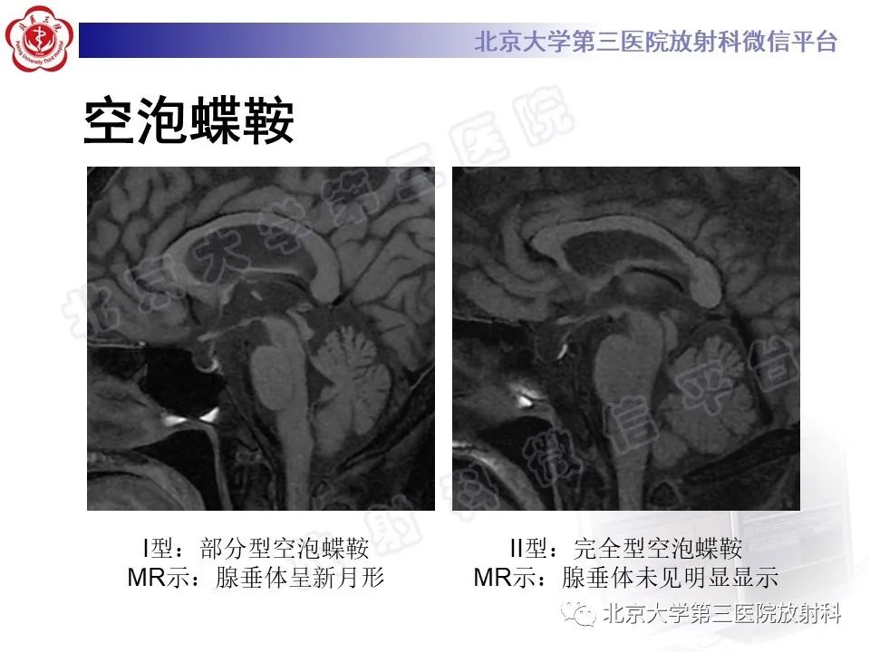 影像PPT - 【PPT】垂体病变的MRI诊断思路-15