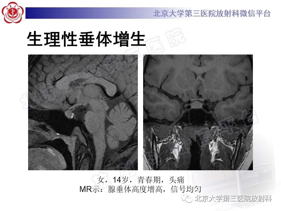 影像PPT - 【PPT】垂体病变的MRI诊断思路-17