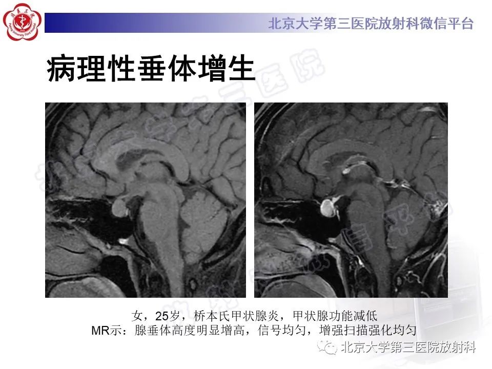 影像PPT - 【PPT】垂体病变的MRI诊断思路-18
