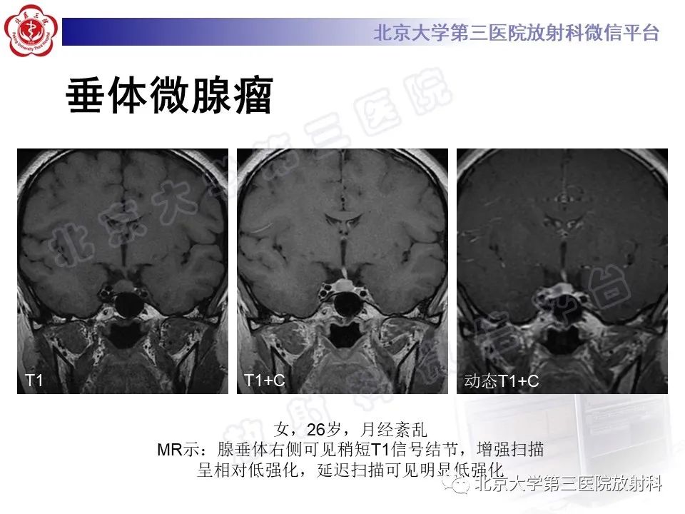 影像PPT - 【PPT】垂体病变的MRI诊断思路-21
