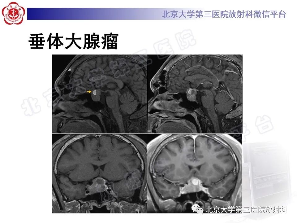 影像PPT - 【PPT】垂体病变的MRI诊断思路-23