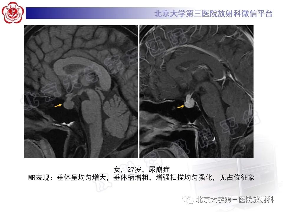 影像PPT - 【PPT】垂体病变的MRI诊断思路-27