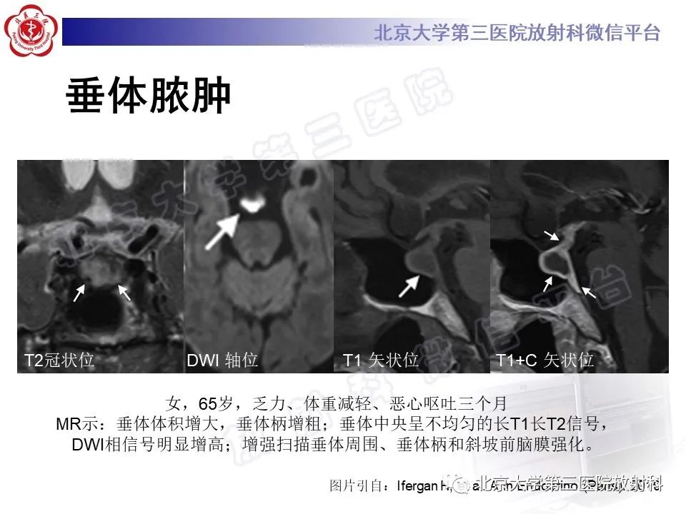 影像PPT - 【PPT】垂体病变的MRI诊断思路-30