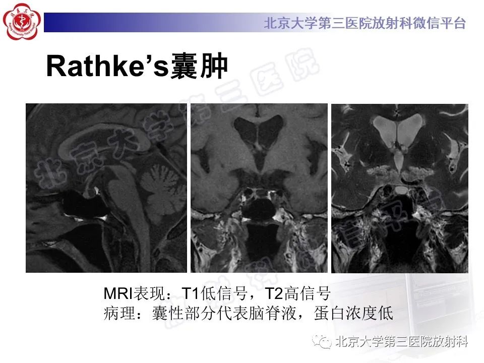 影像PPT - 【PPT】垂体病变的MRI诊断思路-35