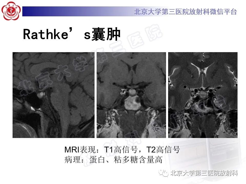 影像PPT - 【PPT】垂体病变的MRI诊断思路-36