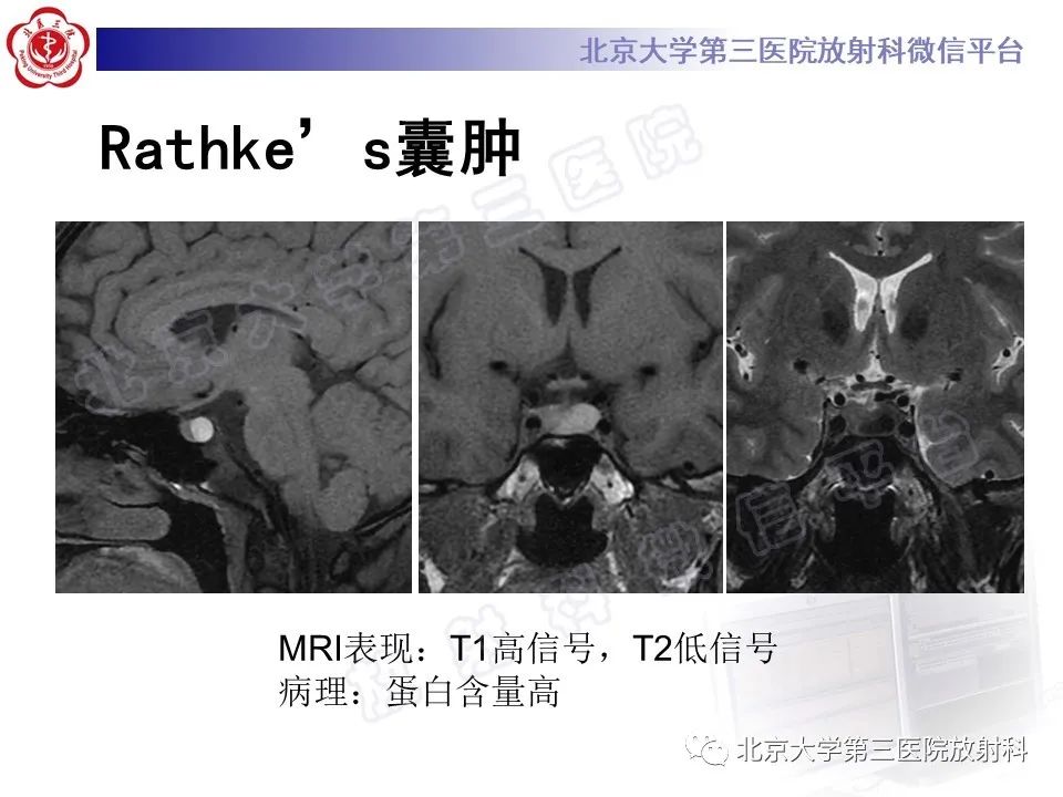 影像PPT - 【PPT】垂体病变的MRI诊断思路-37