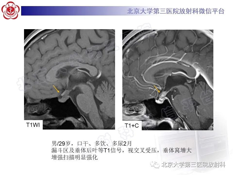 影像PPT - 【PPT】垂体病变的MRI诊断思路-40