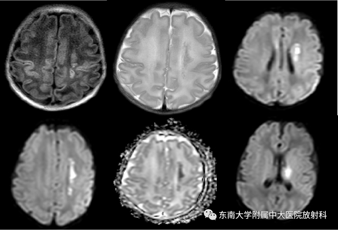 影像PPT - 【PPT】新生儿缺氧缺血性脑病-1
