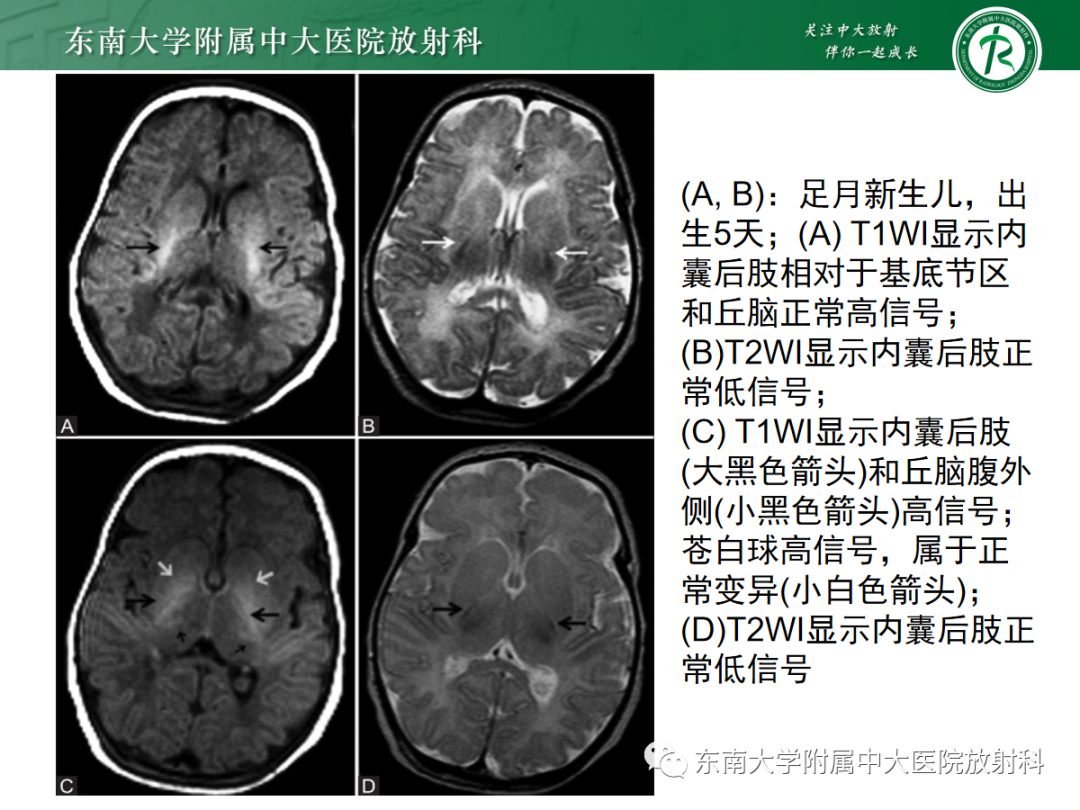 影像PPT - 【PPT】新生儿缺氧缺血性脑病-11