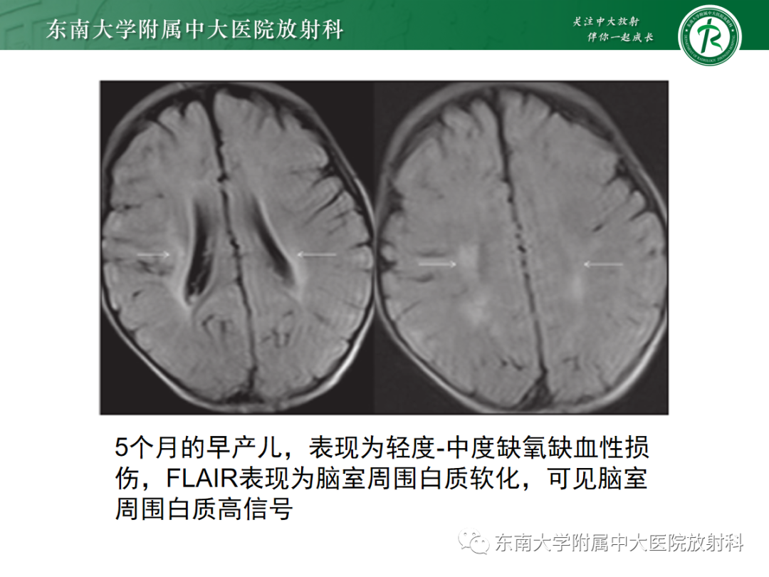 影像PPT - 【PPT】新生儿缺氧缺血性脑病-15