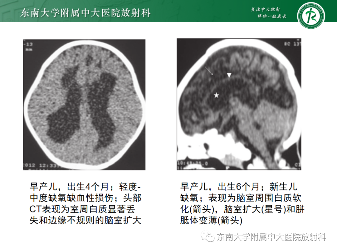影像PPT - 【PPT】新生儿缺氧缺血性脑病-17
