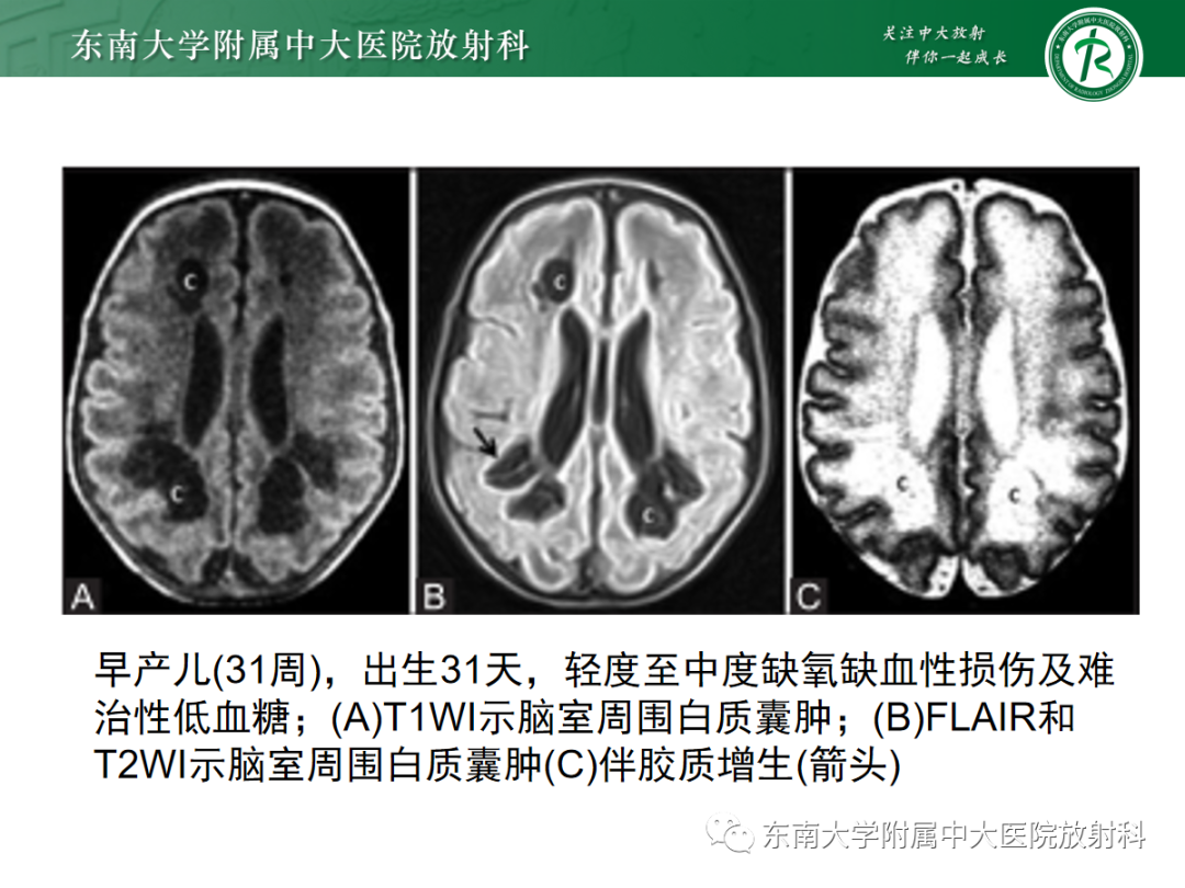 影像PPT - 【PPT】新生儿缺氧缺血性脑病-16