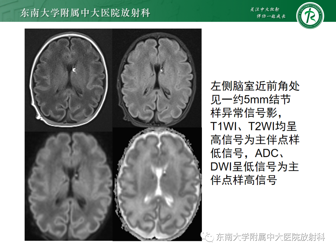 影像PPT - 【PPT】新生儿缺氧缺血性脑病-20