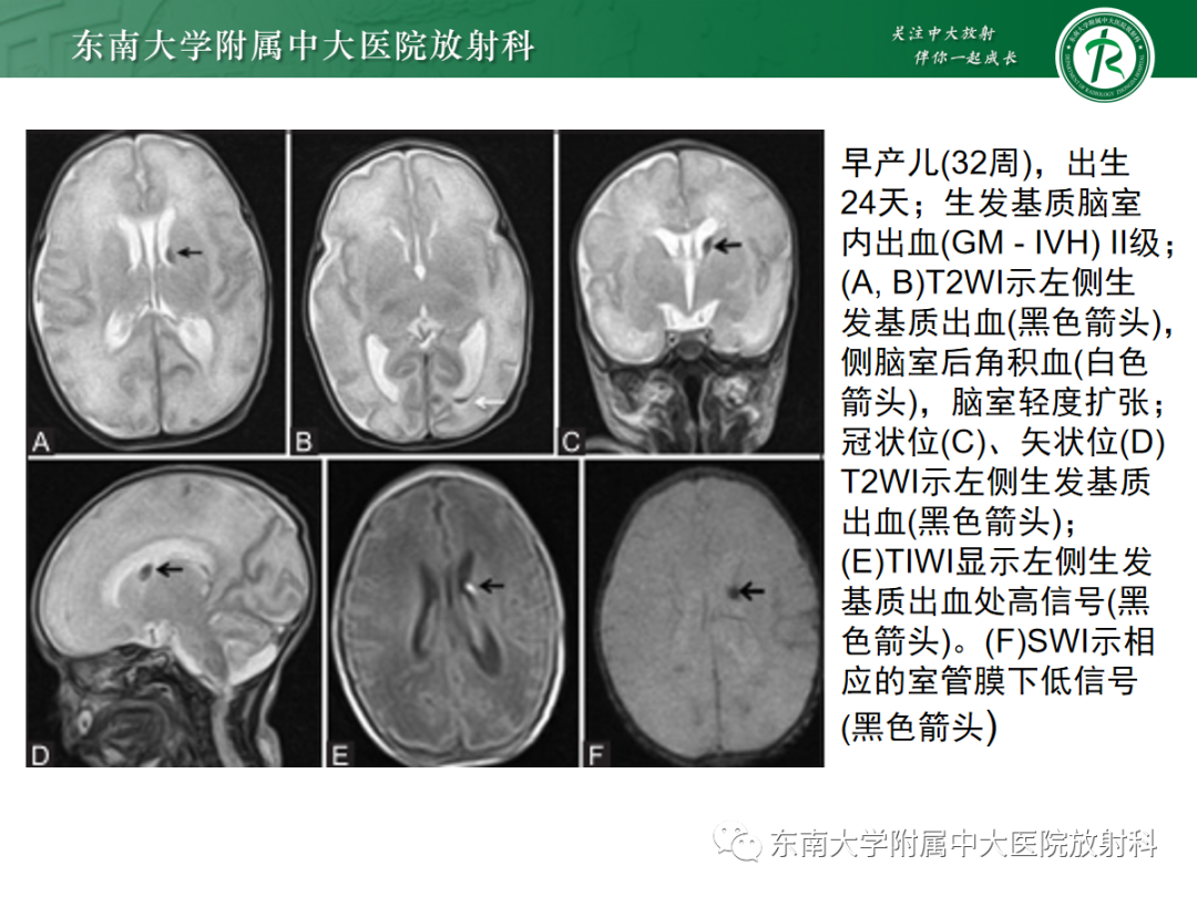 影像PPT - 【PPT】新生儿缺氧缺血性脑病-21