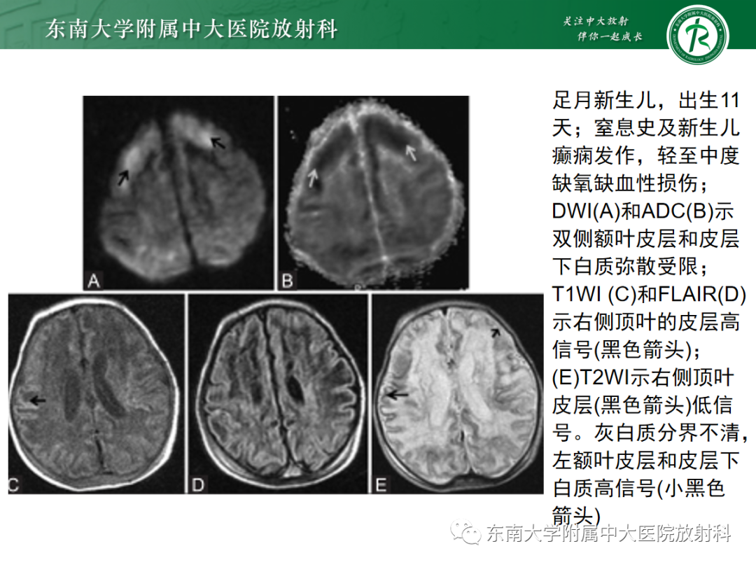影像PPT - 【PPT】新生儿缺氧缺血性脑病-24