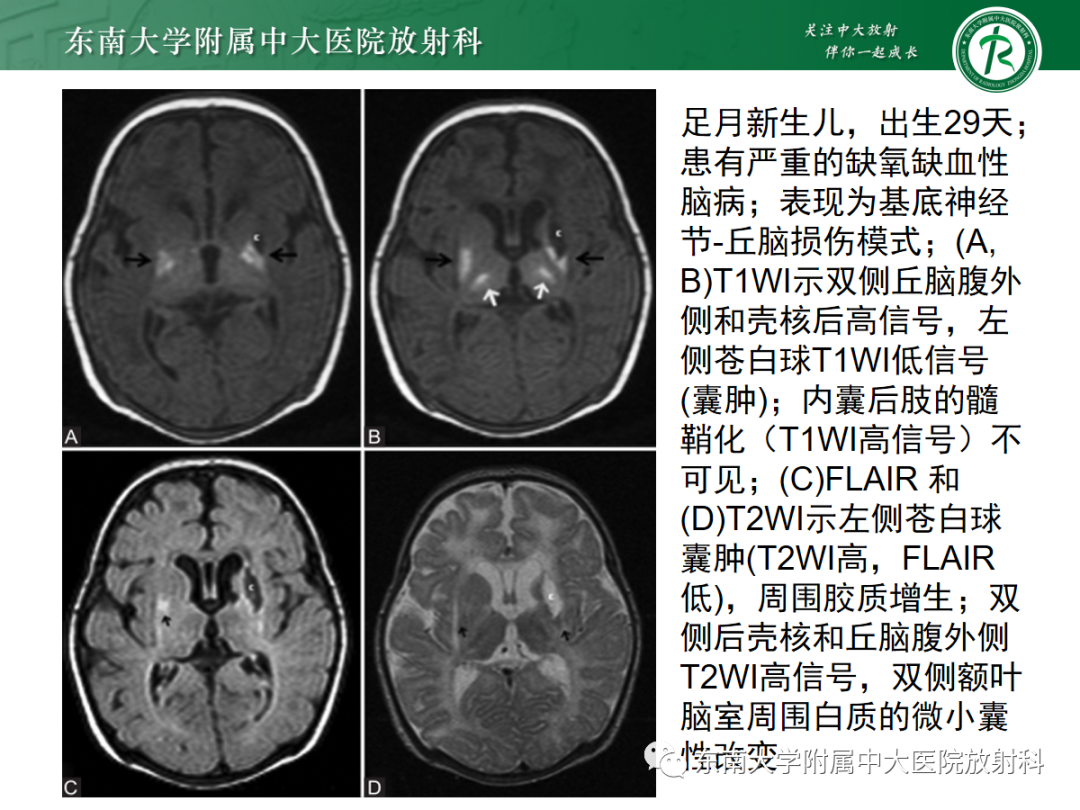 影像PPT - 【PPT】新生儿缺氧缺血性脑病-26