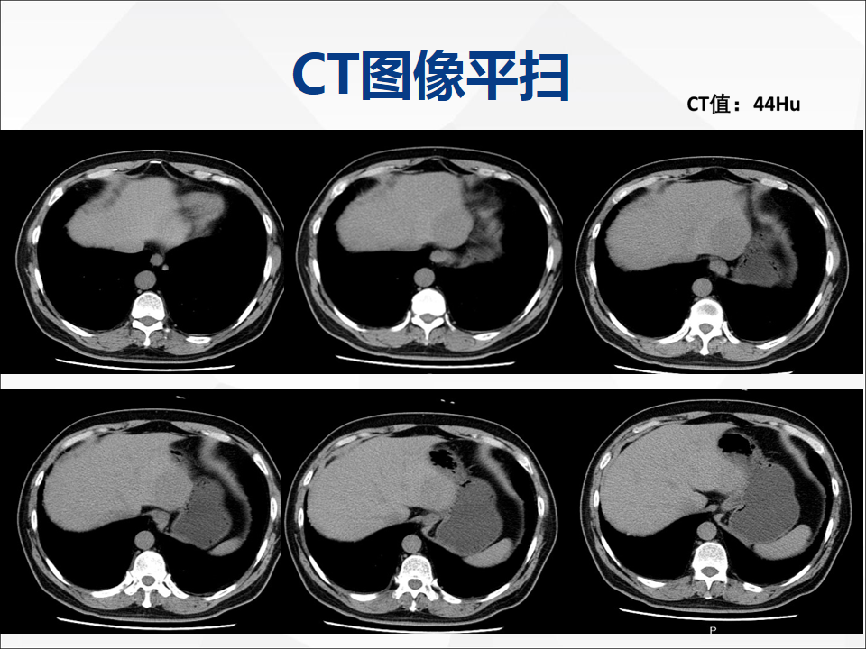 影像PPT - 【病例】肝脏神经内分泌肿瘤1例CT及MR-3