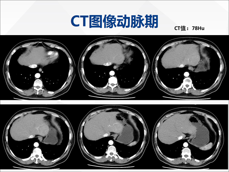 影像PPT - 【病例】肝脏神经内分泌肿瘤1例CT及MR-4