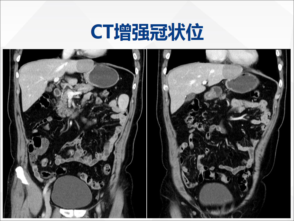影像PPT - 【病例】肝脏神经内分泌肿瘤1例CT及MR-6