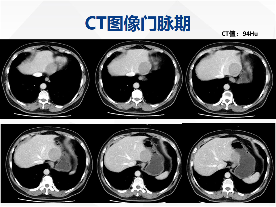 影像PPT - 【病例】肝脏神经内分泌肿瘤1例CT及MR-5
