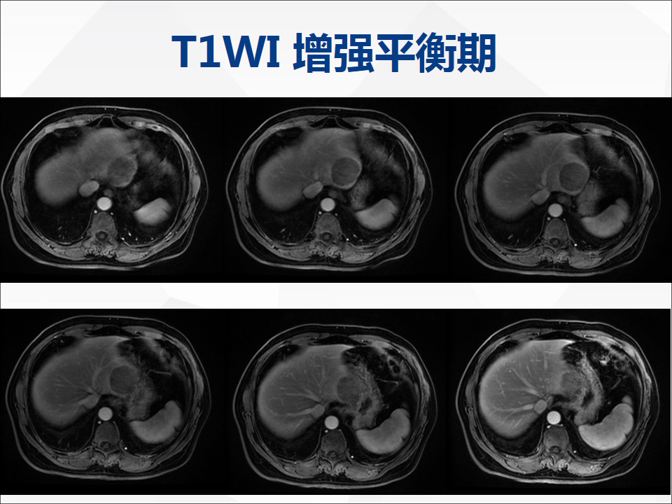影像PPT - 【病例】肝脏神经内分泌肿瘤1例CT及MR-11